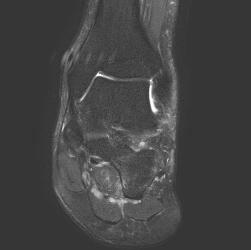 File:Aneurysmal bone cyst of the calcaneus (Radiopaedia 60669-68420 Coronal T2 fat sat 7).jpg