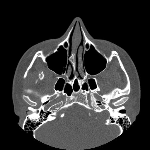 Aneurysmal bone cyst of the mandible (Radiopaedia 43280-46823 Axial bone window 141).jpg