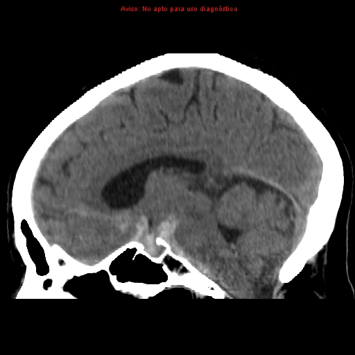 File:Aneurysmal subarachnoid hemorrhage (Radiopaedia 24740-24997 non-contrast 25).jpg