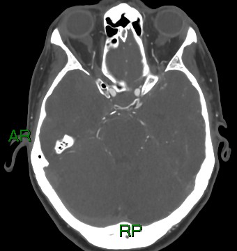 File:Aneurysmal subarachnoid hemorrhage with intra-axial extension (Radiopaedia 84371-99732 A 34).jpg