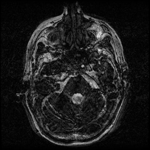 Angioinvasive aspergillosis in the pituitary fossa (Radiopaedia 39676-42010 Ax 3D FIESTA VOLUME 23).png