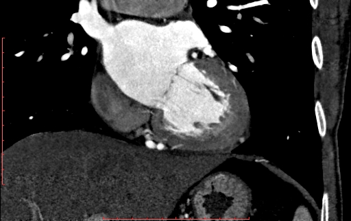 Anomalous left coronary artery from the pulmonary artery (ALCAPA) (Radiopaedia 70148-80181 B 168).jpg