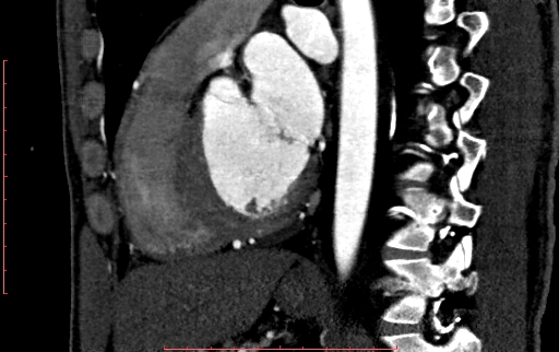 File:Anomalous left coronary artery from the pulmonary artery (ALCAPA) (Radiopaedia 70148-80181 C 143).jpg