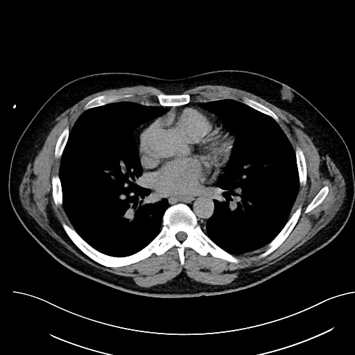 File:Anomalous origin of the left coronary artery with malignant course (Radiopaedia 77842-90126 Axial non-contrast 19).jpeg