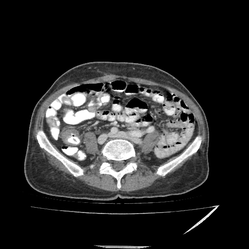 Anorectal carcinoma (Radiopaedia 44413-48064 A 36).jpg