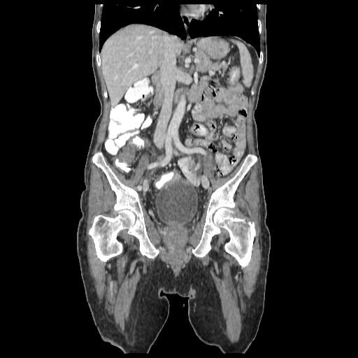 Anorectal carcinoma (Radiopaedia 44413-48064 B 41).jpg