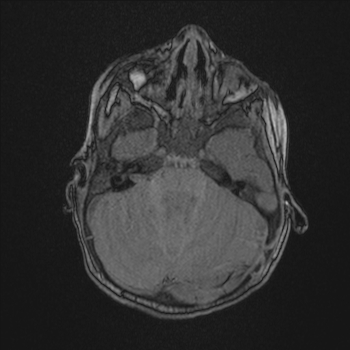Anoxic brain injury (Radiopaedia 79165-92139 Axial MRA 60).jpg