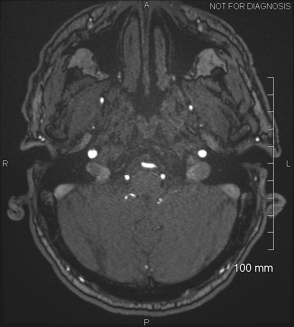 Anterior cerebral artery aneurysm (Radiopaedia 80683-94127 Axial MRA 33).jpg
