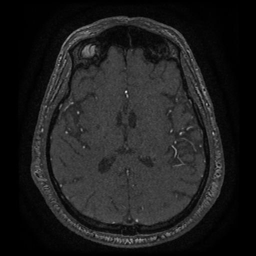Anterior cerebral artery infarction (Radiopaedia 46794-51323 Axial MRA 121).jpg