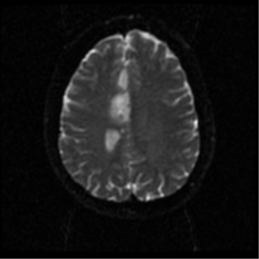 File:Anterior cerebral artery territory infarct (Radiopaedia 39327-41584 Axial DWI 43).png