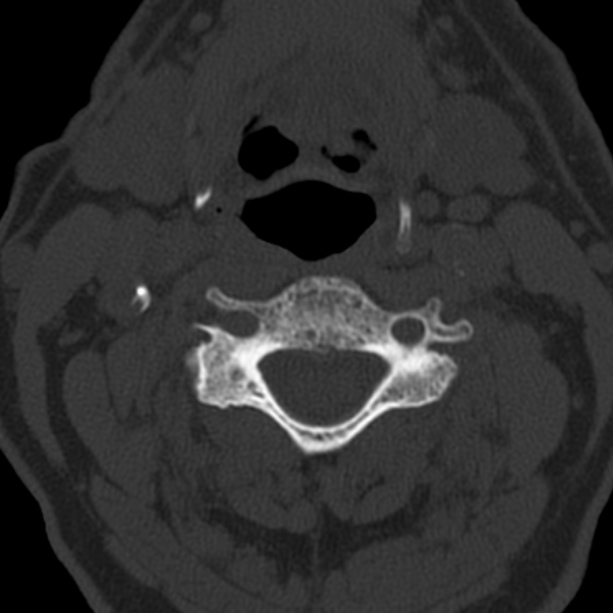 Anterior cervical postdiscectomy arthrodesis (Radiopaedia 32678-33646 Axial bone window 35).jpg