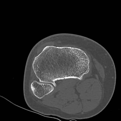 File:Anterior cruciate ligament avulsion fracture (Radiopaedia 58939-66194 Axial bone window 27).jpg