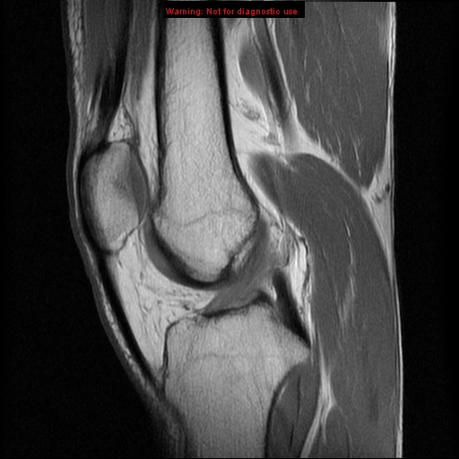 File:Anterior cruciate ligament injury - partial thickness tear (Radiopaedia 12176-12515 Sagittal PD 10).jpg