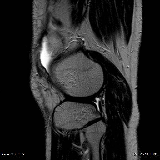 File:Anterior cruciate ligament tear (Radiopaedia 70783-80964 Sagittal T2 25).jpg