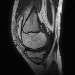 Anterior cruciate ligament tear - pediatric (Radiopaedia 62152-70260 Sagittal PD 49).jpg