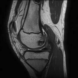 Anterior cruciate ligament tear - pediatric (Radiopaedia 62152-70260 Sagittal PD 66).jpg