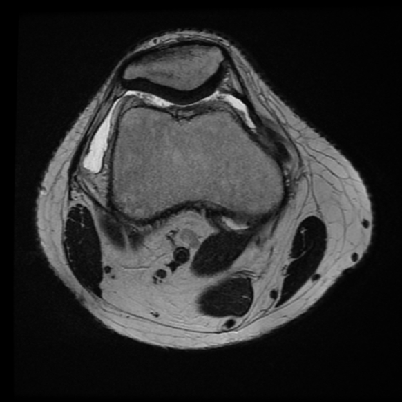 File:Anterior cruciate ligament tear with posteromedial corner injury, bucket-handle meniscal tear and chondral delamination (Radiopaedia 75501-86744 Axial T2 20).jpg