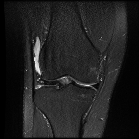 File:Anterior cruciate ligament tear with posteromedial corner injury, bucket-handle meniscal tear and chondral delamination (Radiopaedia 75501-86744 Coronal PD fat sat 11).jpg