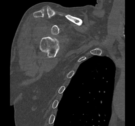 Anterior glenohumeral dislocation with Hill-Sachs lesion (Radiopaedia 62877-71249 Coronal bone window 17).jpg