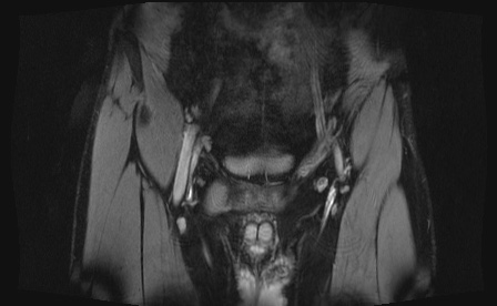 Anterior inferior iliac spine avulsion fracture (Radiopaedia 81312-95000 G 96).jpg