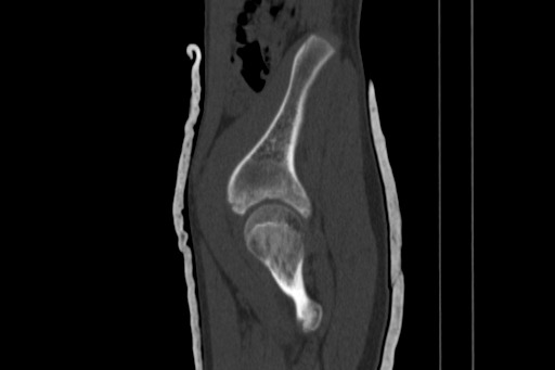 Anterior inferior iliac spine avulsion injury (Radiopaedia 88666-105376 Sagittal bone window 25).jpg