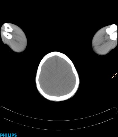 File:Anterior mediastinal seminoma (Radiopaedia 80270-93613 C 1).jpg