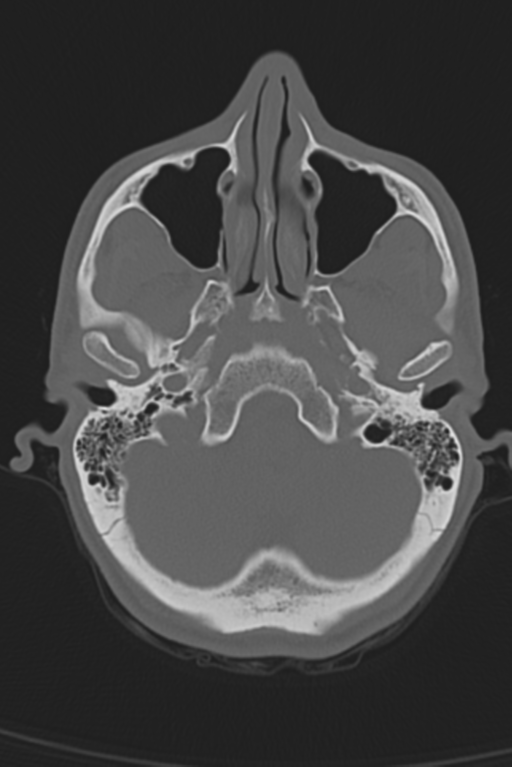 Anterior nasal spine fracture (Radiopaedia 46138-50494 Axial bone window 47).png