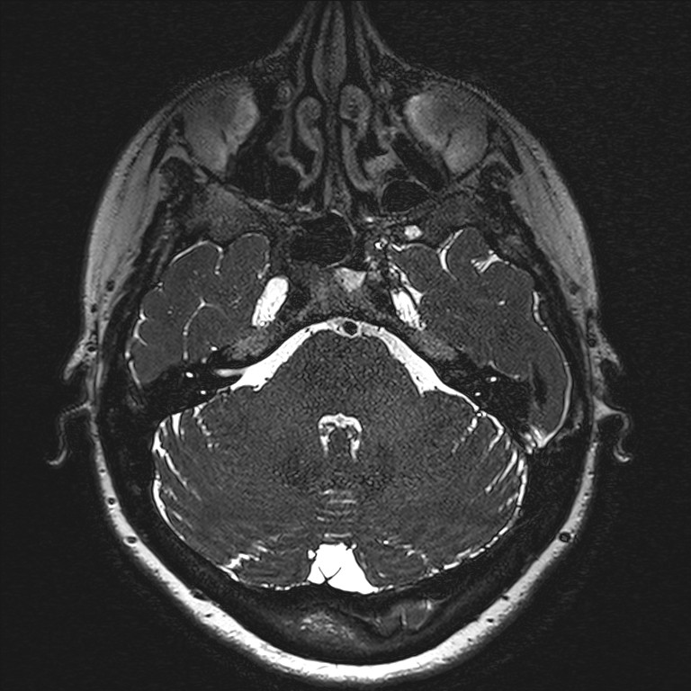Anterior temporal encephalocele (Radiopaedia 82624-96808 Axial T2 high res 26).jpg