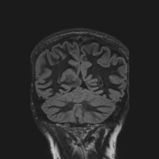 Anterior temporal encephalocele (Radiopaedia 82624-96808 Coronal FLAIR 40).jpg