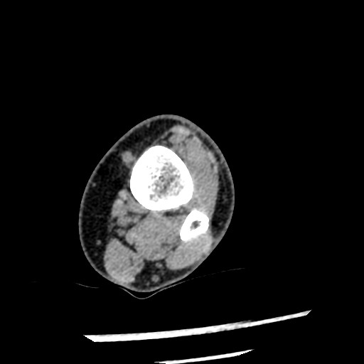 File:Anterior tibial artery false aneurysm (Radiopaedia 88984-105809 A 60).jpg