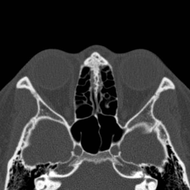 Antrochoanal polyp (Radiopaedia 33984-35202 Axial bone window 51).jpg