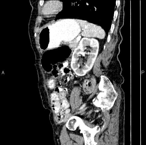 Aortic aneurysm and Lemmel syndrome (Radiopaedia 86499-102554 D 65).jpg