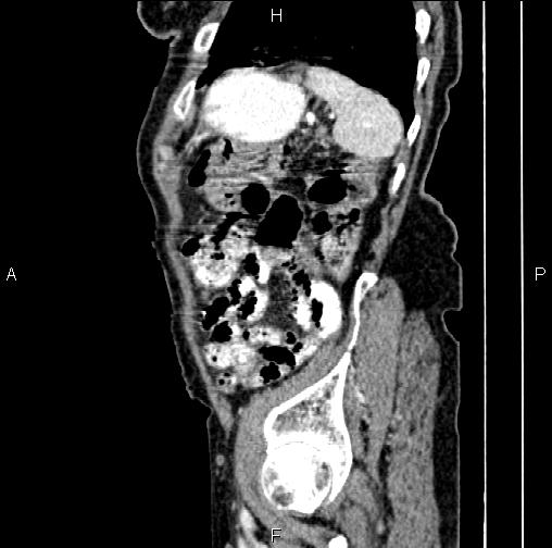 File:Aortic aneurysm and Lemmel syndrome (Radiopaedia 86499-102554 D 75).jpg