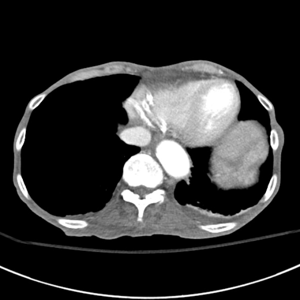 File:Aortic aneurysm with spinal destruction (Radiopaedia 42301-45410 A 7).jpg