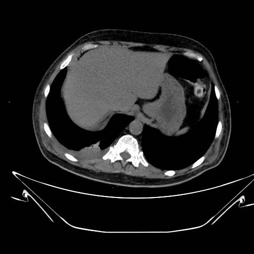 Aortic arch aneurysm (Radiopaedia 84109-99365 Axial non-contrast 251).jpg