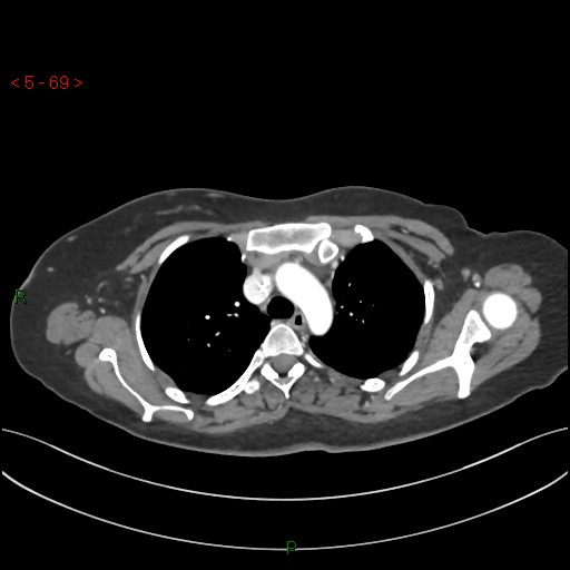 File:Aortic arch origin of left vertebral artery (Radiopaedia 51520-57286 A 68).jpg