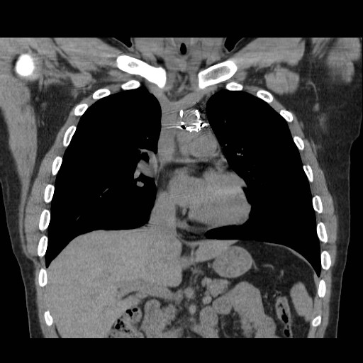 File:Aortic arch stent (Radiopaedia 30030-30595 Coronal non-contrast 7).jpg