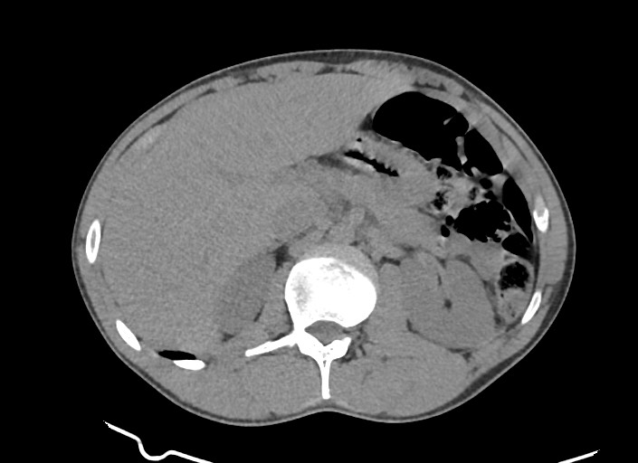 File:Aortic coarctation with aneurysm (Radiopaedia 74818-85828 A 18).jpg
