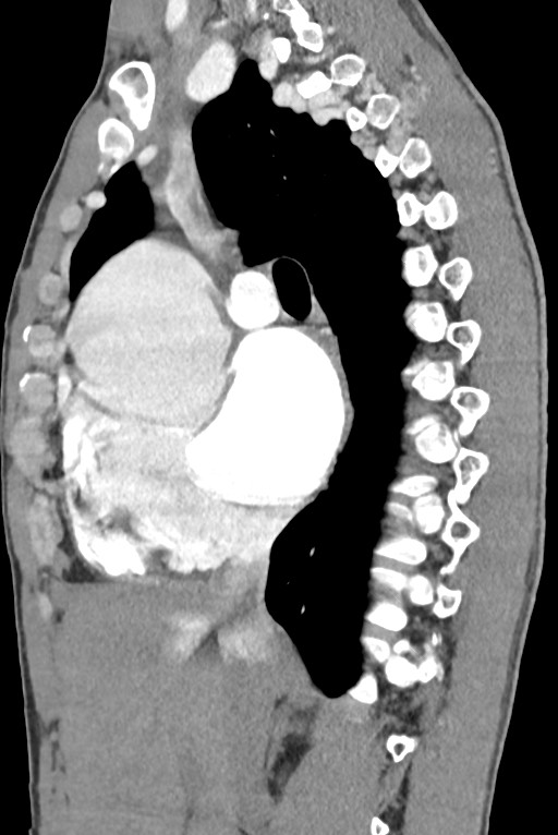 Aortic coarctation with aneurysm (Radiopaedia 74818-85828 B 70).jpg