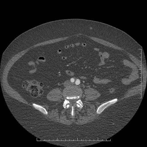 File:Aortic dissection- Stanford A (Radiopaedia 35729-37268 C 38).jpg