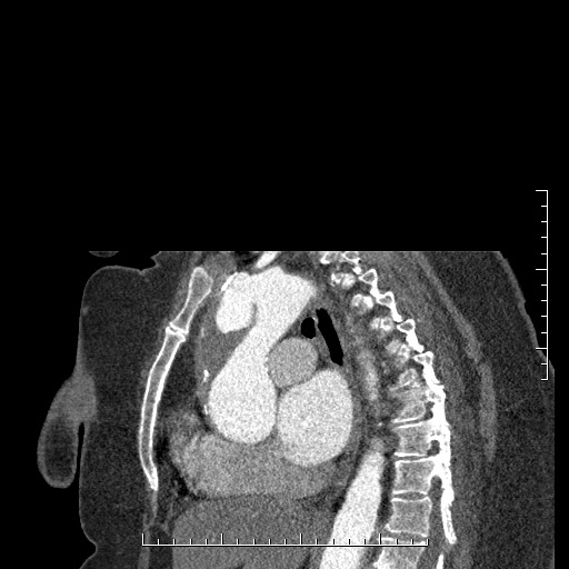 File:Aortic dissection- Stanford A (Radiopaedia 35729-37268 D 25).jpg