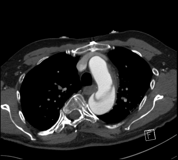 Aortic dissection (CTPA) (Radiopaedia 75506-86750 A 28).jpg