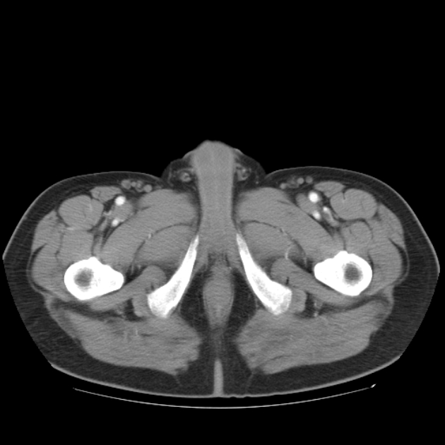 Aortic dissection (Radiopaedia 44411-48061 C 62).jpg