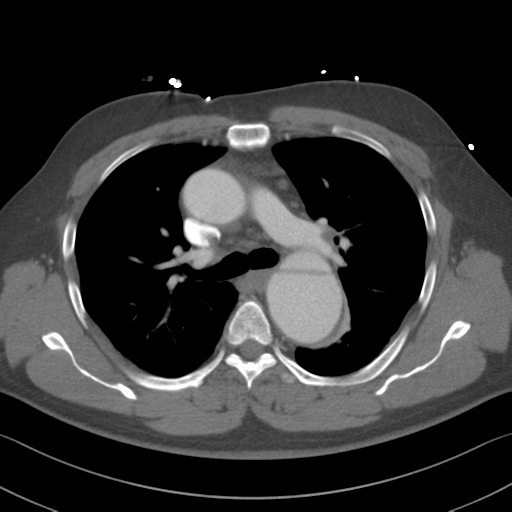 File:Aortic dissection (Radiopaedia 50763-56234 A 22).png