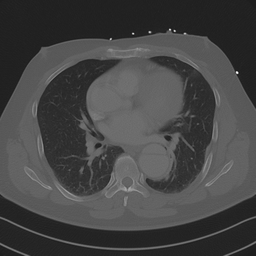 Aortic dissection (Radiopaedia 50763-56234 Axial bone window 57).png