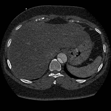 File:Aortic dissection (Radiopaedia 57969-64959 A 277).jpg