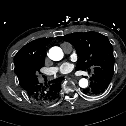 File:Aortic dissection - DeBakey type II (Radiopaedia 64302-73082 A 45).png