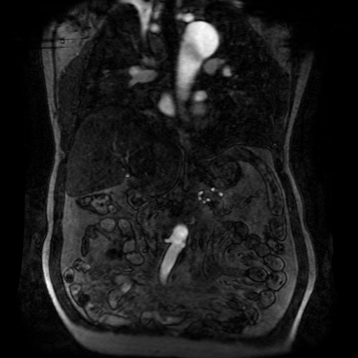 File:Aortic dissection - Stanford A - DeBakey I (Radiopaedia 23469-23551 D 113).jpg