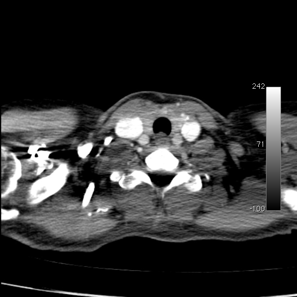 Aortic dissection - Stanford type A (Radiopaedia 29247-29659 A 4).jpg