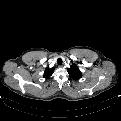 Aortic dissection - Stanford type A (Radiopaedia 83418-98500 A 7).jpg